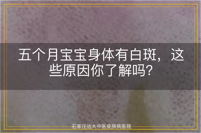 五个月宝宝身体有白斑，这些原因你了解吗？