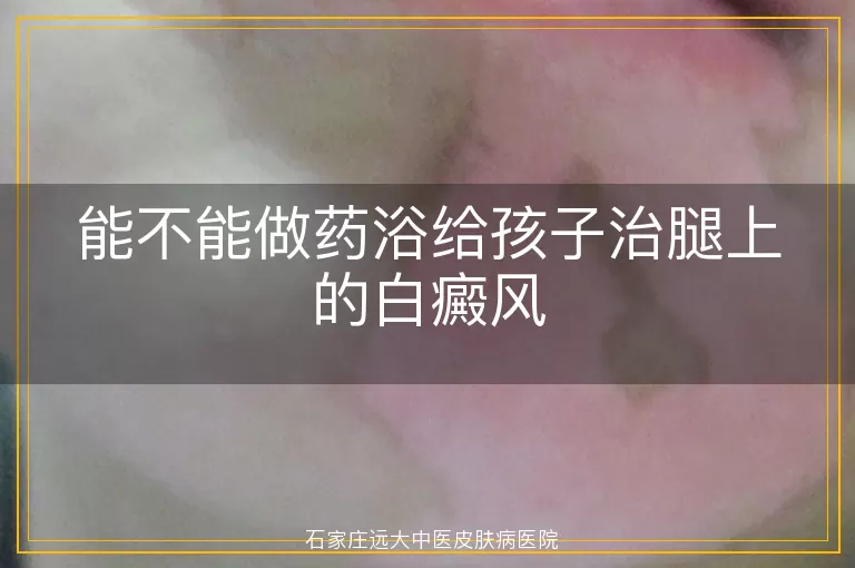 能不能做药浴给孩子治腿上的白癜风