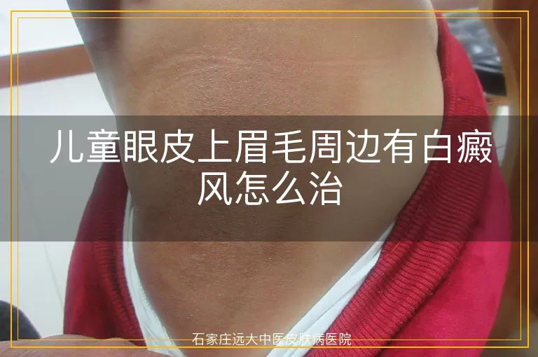 儿童眼皮上眉毛周边有白癜风怎么治