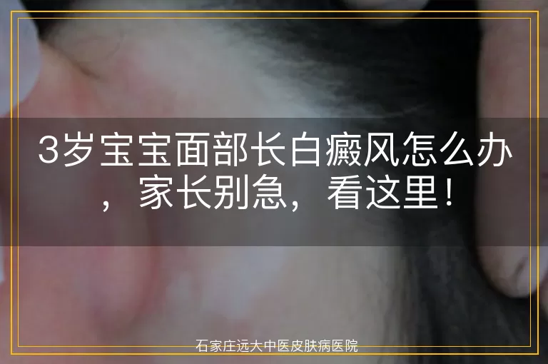 3岁宝宝面部长白癜风怎么办，家长别急，看这里！