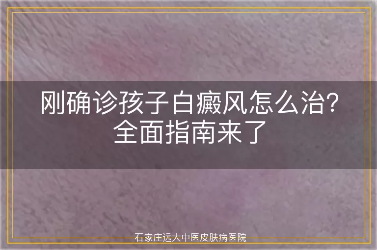 刚确诊孩子白癜风怎么治？全面指南来了
