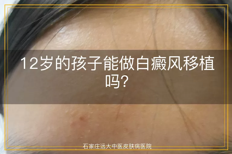12岁的孩子能做白癜风移植吗？