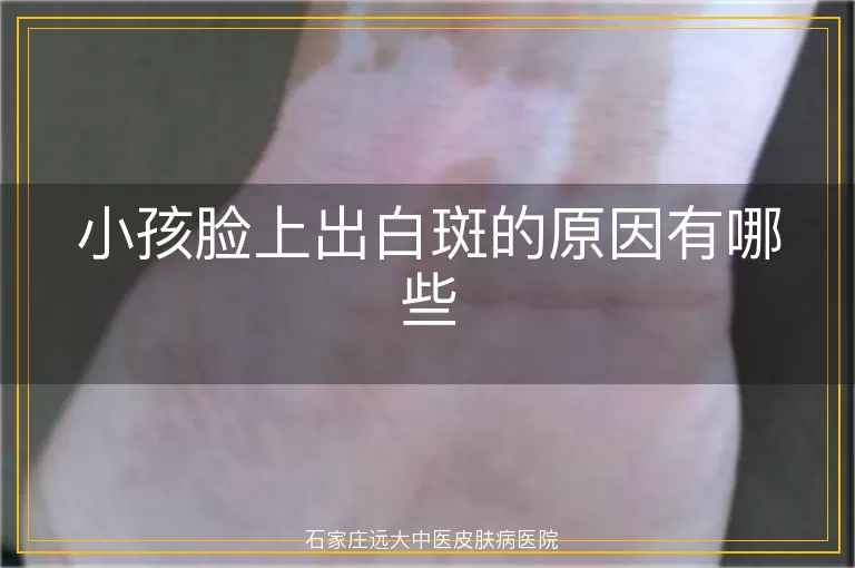 小孩脸上出白斑的原因有哪些