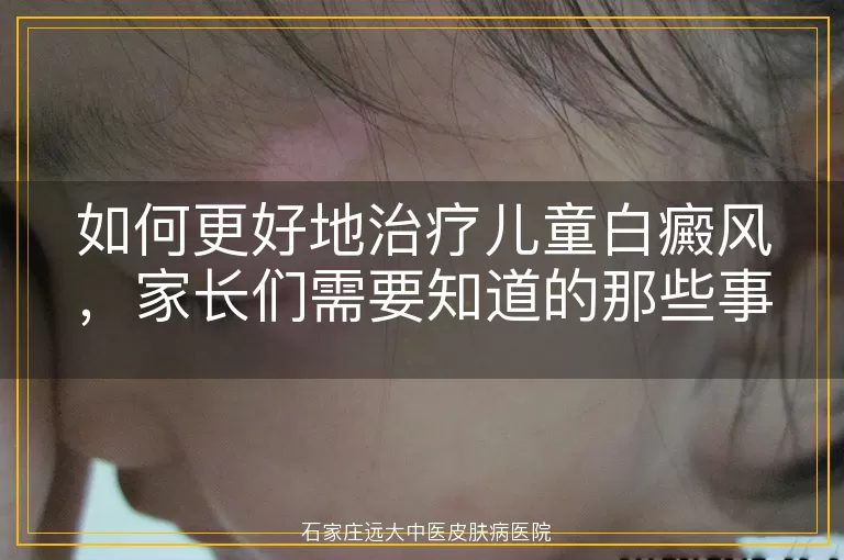 如何更好地治疗儿童白癜风，家长们需要知道的那些事儿