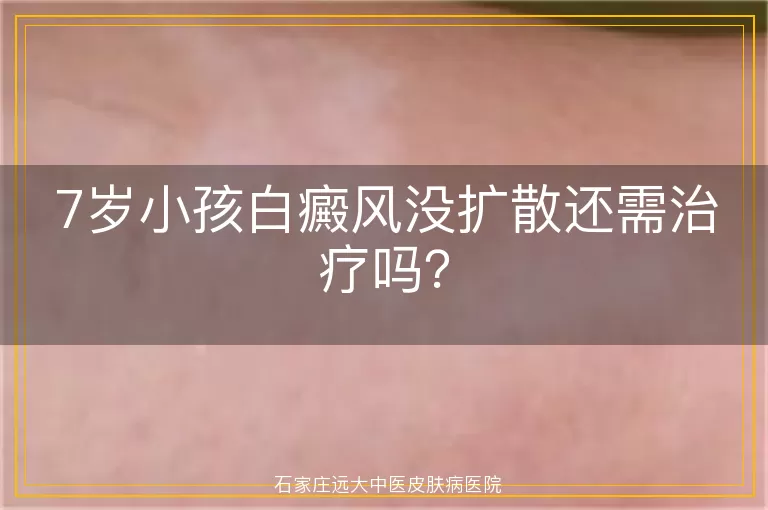 7岁小孩白癜风没扩散还需治疗吗？