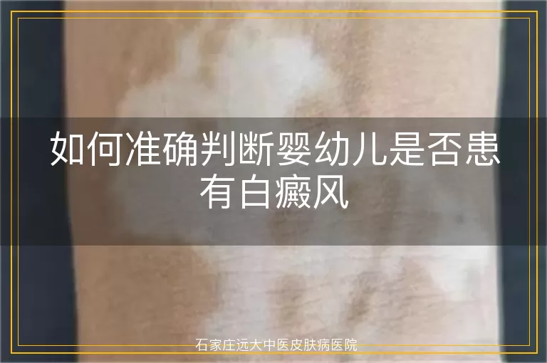 如何准确判断婴幼儿是否患有白癜风