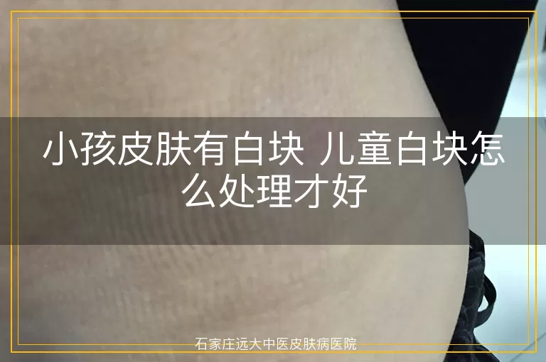 小孩皮肤有白块 儿童白块怎么处理才好