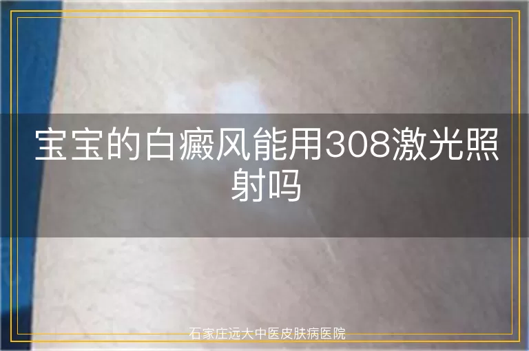 宝宝的白癜风能用308激光照射吗