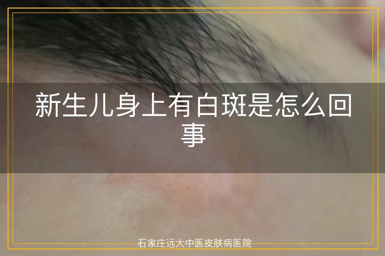 新生儿身上有白斑是怎么回事