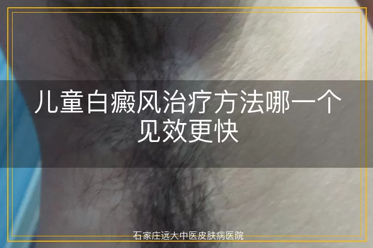 儿童白癜风治疗方法哪一个见效更快