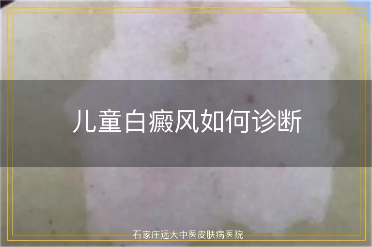 儿童白癜风如何诊断