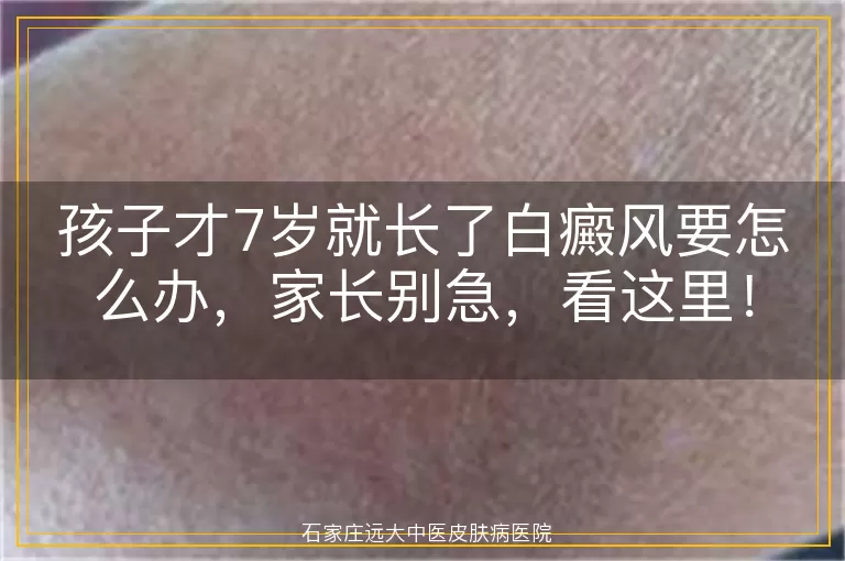 孩子才7岁就长了白癜风要怎么办，家长别急，看这里！