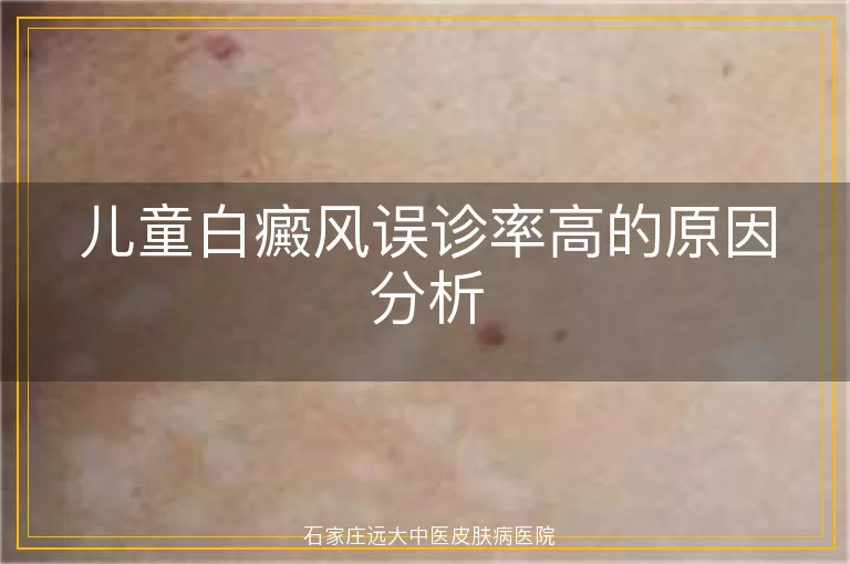 儿童白癜风误诊率高的原因分析