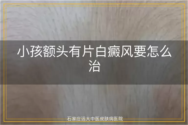 小孩额头有片白癜风要怎么治