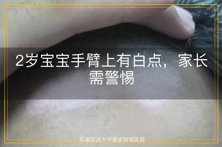 2岁宝宝手臂上有白点，家长需警惕
