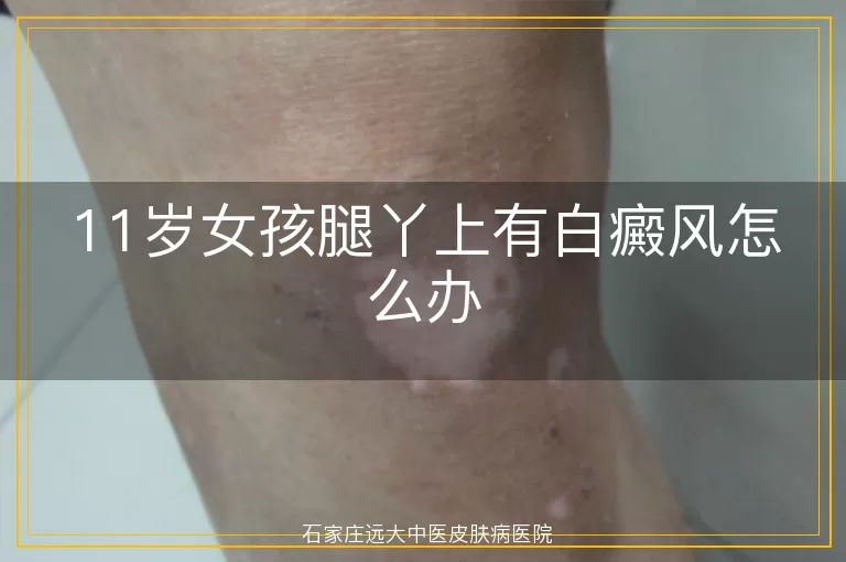 11岁女孩腿丫上有白癜风怎么办