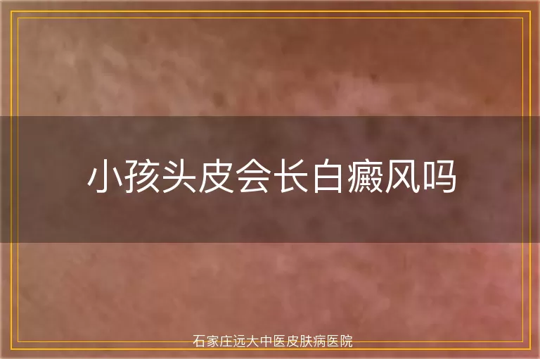 小孩头皮会长白癜风吗