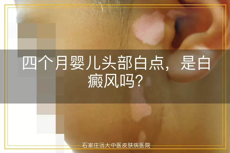 四个月婴儿头部白点，是白癜风吗？