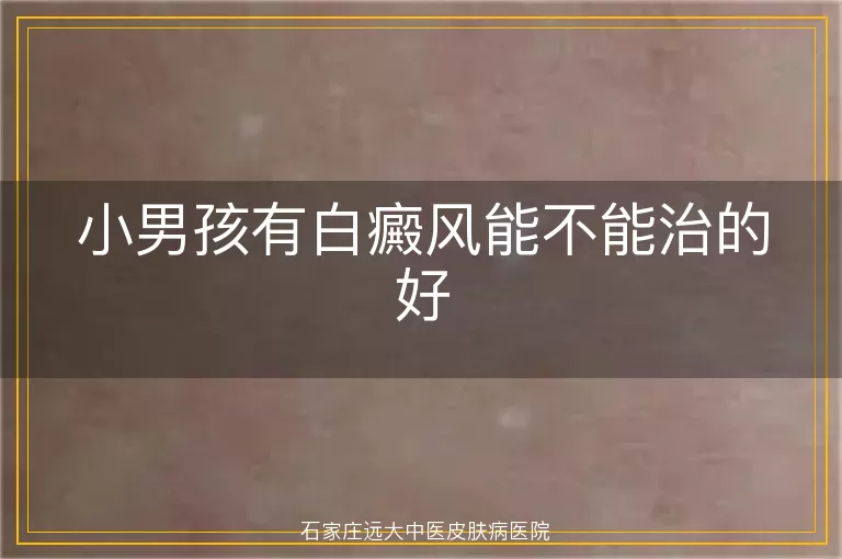 小男孩有白癜风能不能治的好