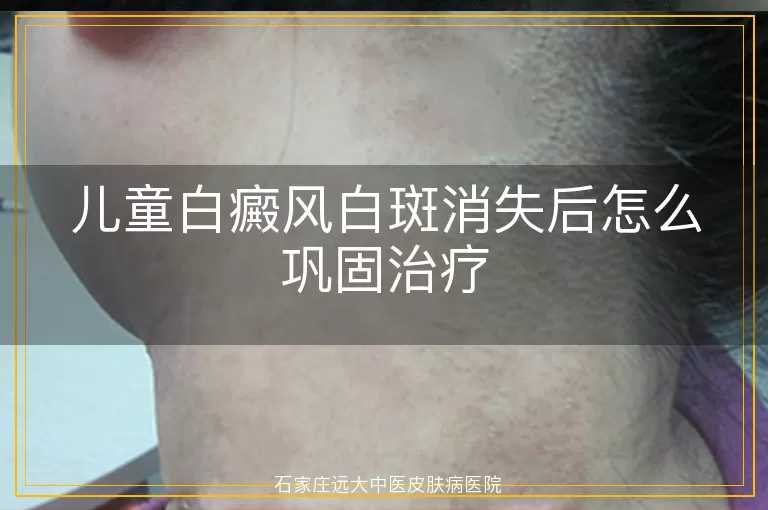 儿童白癜风白斑消失后怎么巩固治疗