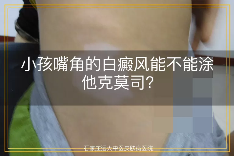 小孩嘴角的白癜风能不能涂他克莫司？