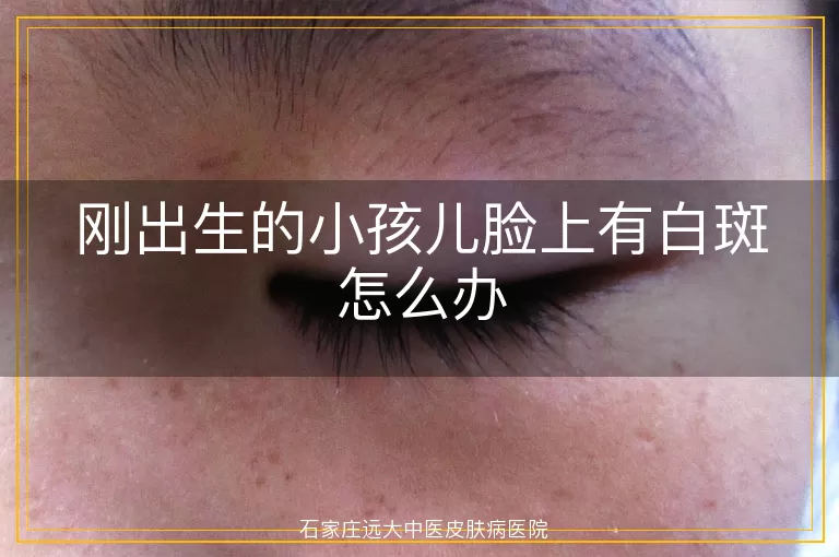刚出生的小孩儿脸上有白斑怎么办