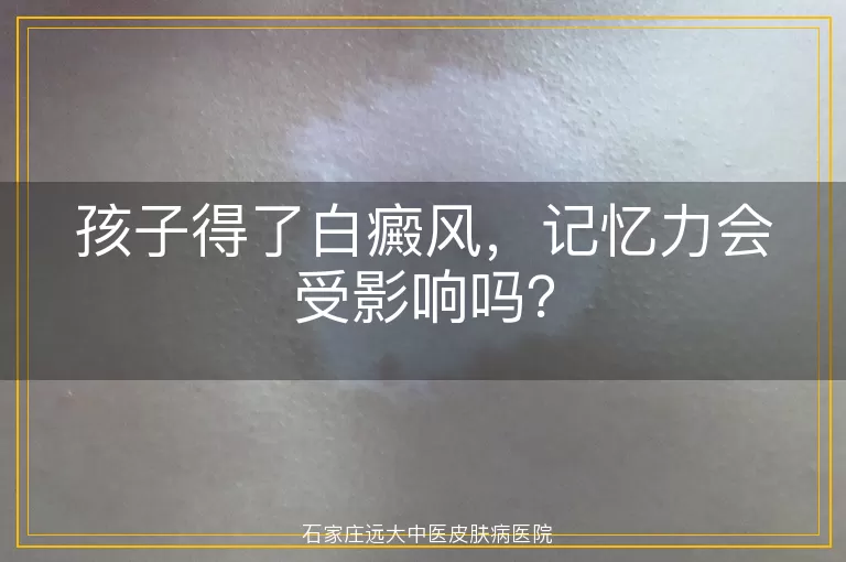 孩子得了白癜风，记忆力会受影响吗？