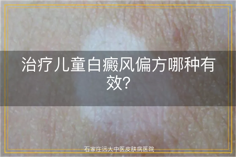 治疗儿童白癜风偏方哪种有效？