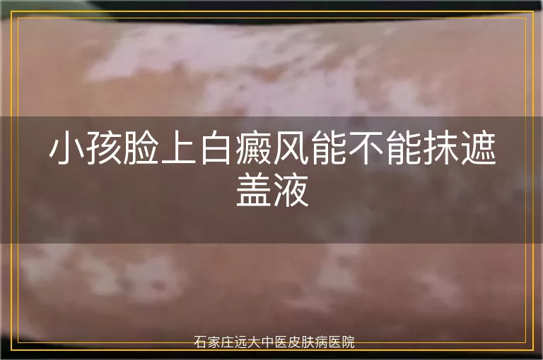 小孩脸上白癜风能不能抹遮盖液