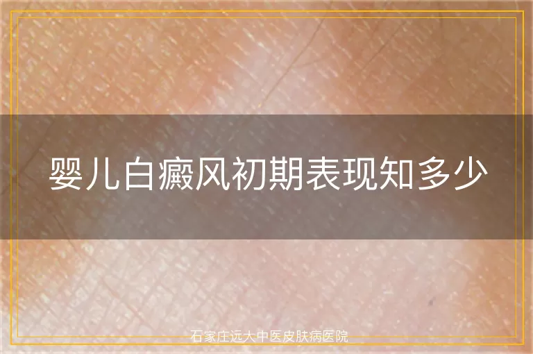 婴儿白癜风初期表现知多少