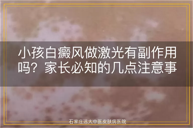 小孩白癜风做激光有副作用吗？家长必知的几点注意事项