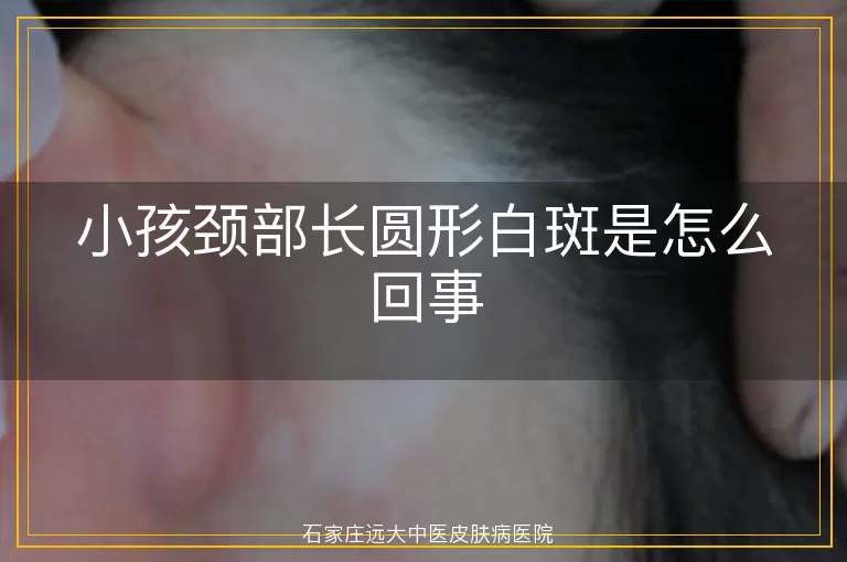 小孩颈部长圆形白斑是怎么回事