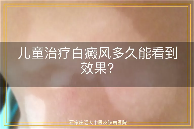 儿童治疗白癜风多久能看到效果？