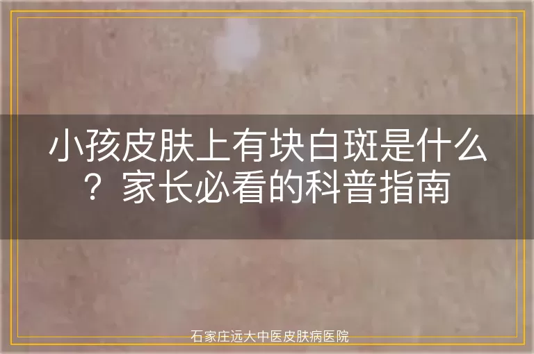 小孩皮肤上有块白斑是什么？家长必看的科普指南