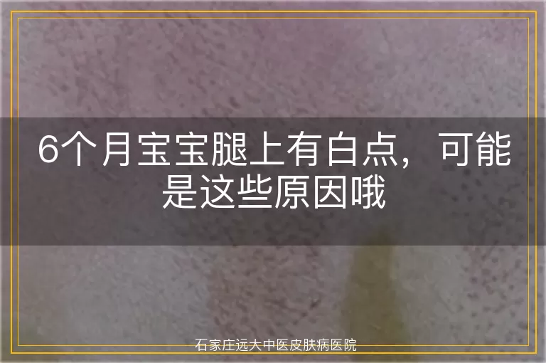 6个月宝宝腿上有白点，可能是这些原因哦