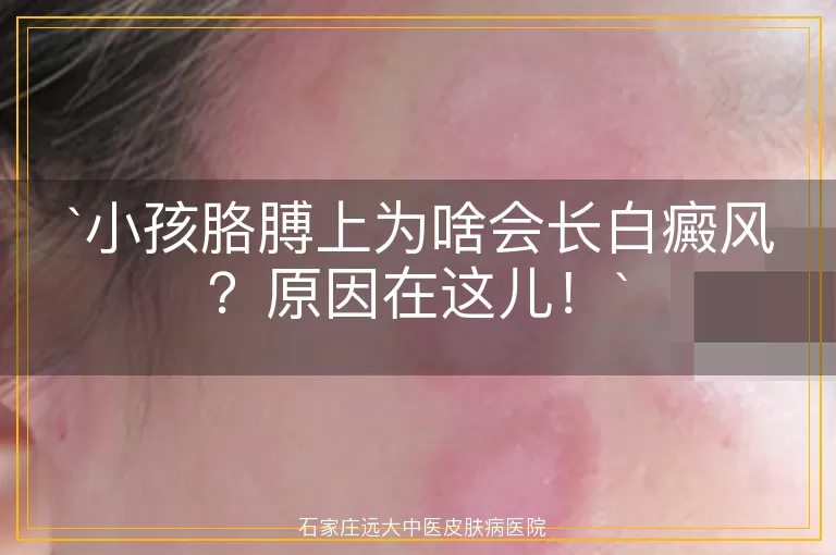 小孩胳膊上为啥会长白癜风？原因在这儿！