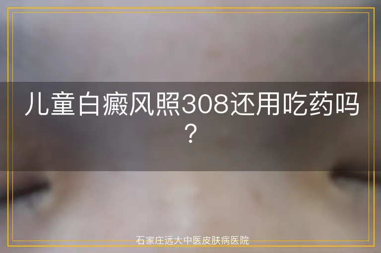 儿童白癜风照308还用吃药吗？