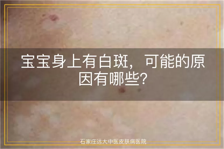 宝宝身上有白斑，可能的原因有哪些？