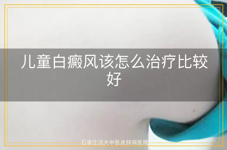 儿童白癜风该怎么治疗比较好
