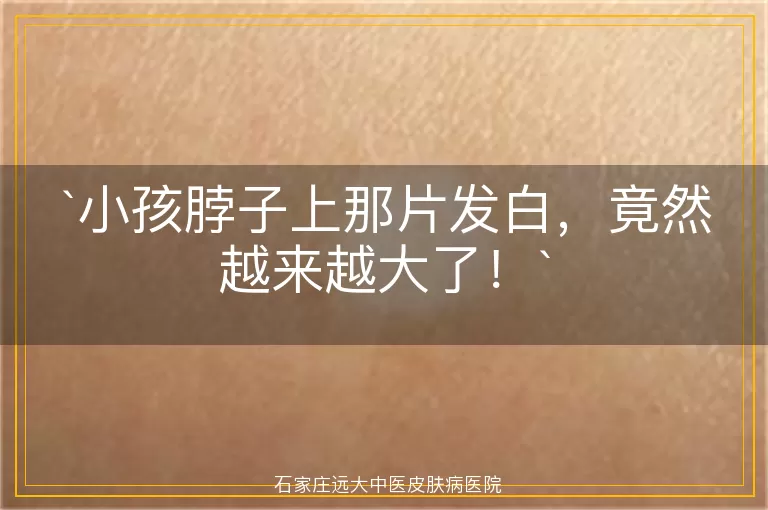 小孩脖子上那片发白，竟然越来越大了！