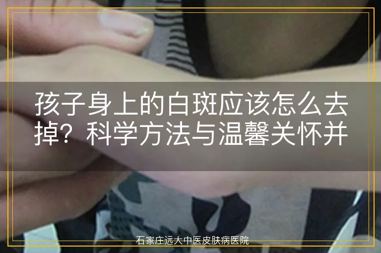 孩子身上的白斑应该怎么去掉？科学方法与温馨关怀并重