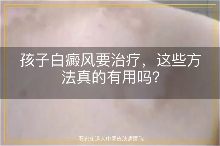 孩子白癜风要治疗，这些方法真的有用吗？