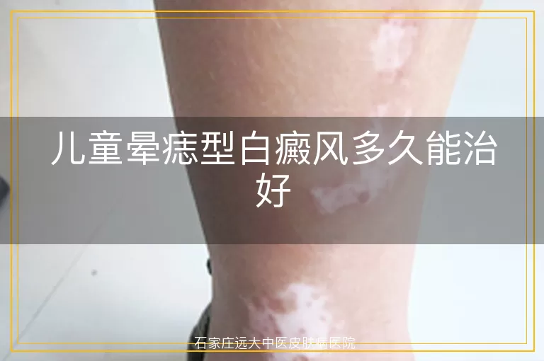 儿童晕痣型白癜风多久能治好