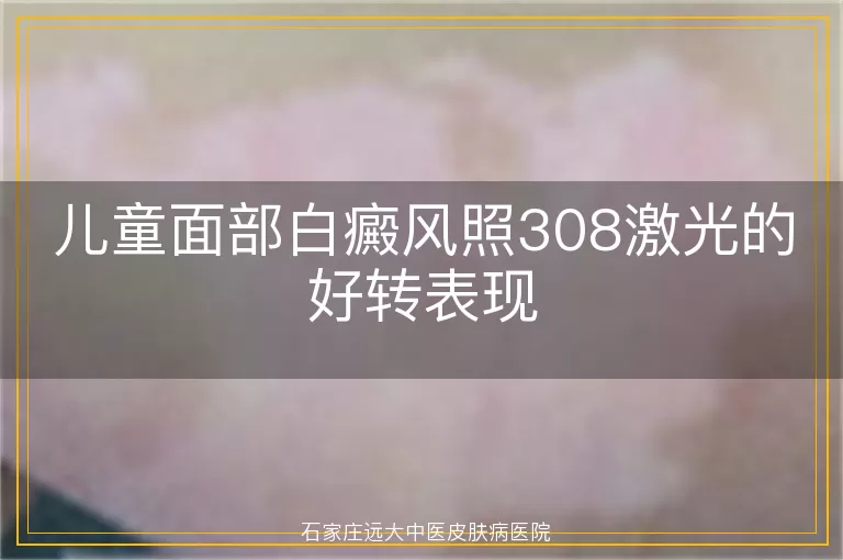儿童面部白癜风照308激光的好转表现