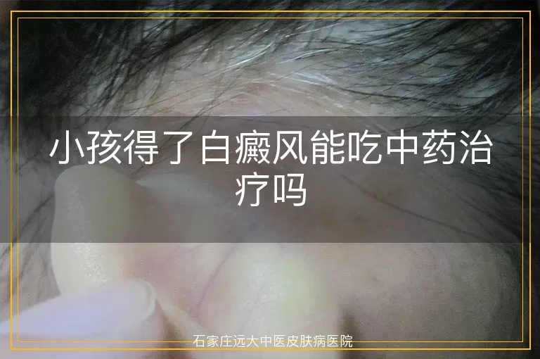 小孩得了白癜风能吃中药治疗吗