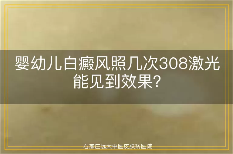 婴幼儿白癜风照几次308激光能见到效果？