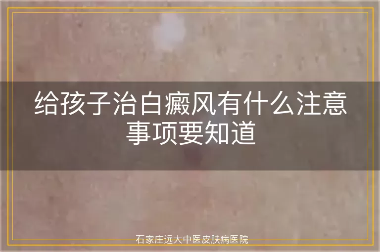 给孩子治白癜风有什么注意事项要知道