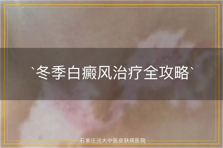 冬季白癜风治疗全攻略