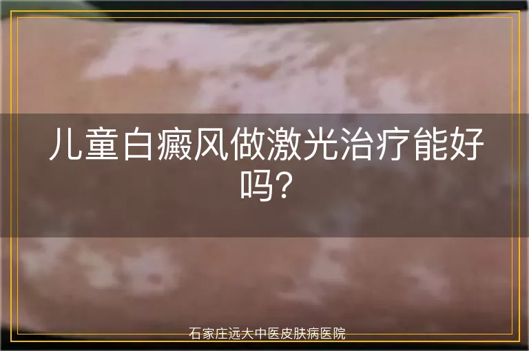 儿童白癜风做激光治疗能好吗？