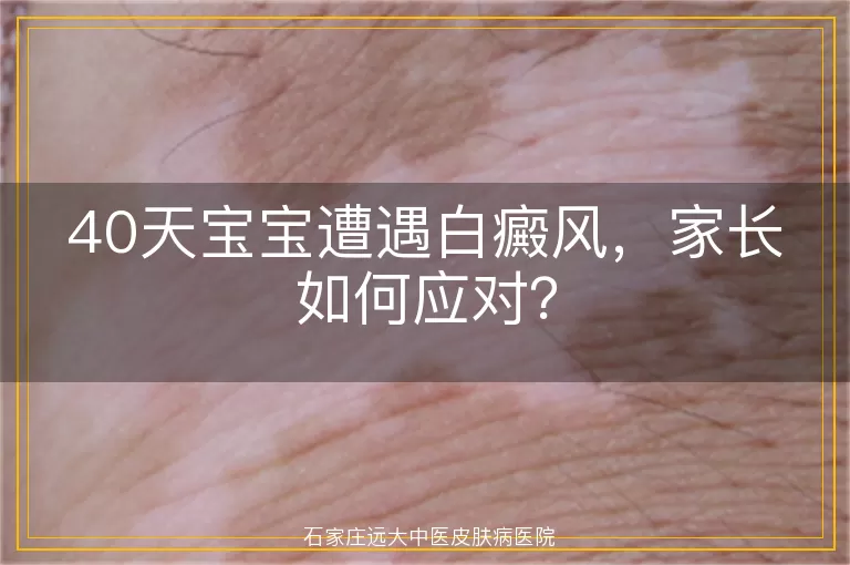 40天宝宝遭遇白癜风，家长如何应对？